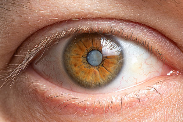 Closeup of a Cataract in an Eye