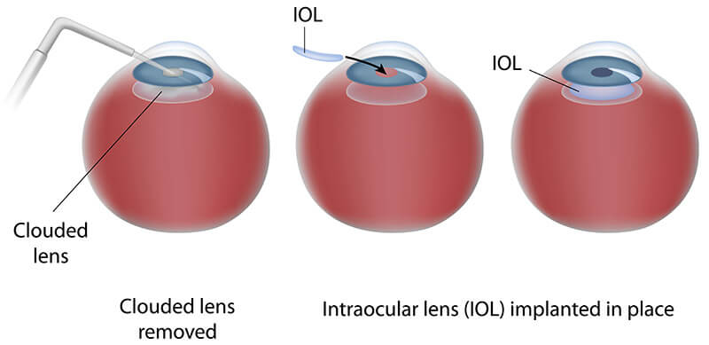 Chart Illustrating the Cataract Surgery Process